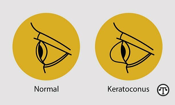 KC occurs when the cornea thins, weakens, and a cone-like bulge forms and distorts vision.