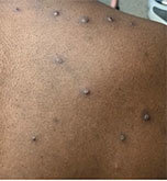 An example of Monkeypox rash