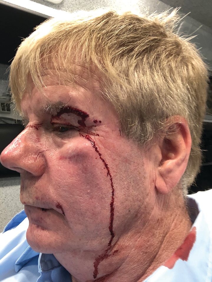 Former Lansing bus driver Craig Nieman shows his injuries in July following a violent encounter with a passenger. He said he was punched in the face after he tried to enforce a mask mandate.
