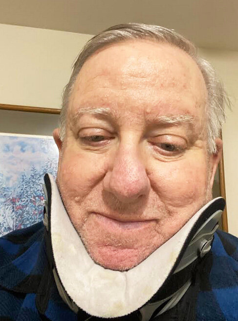 A portrait of the reporter after neck surgery at St. Elizabeth's Hospital in Brighton, Mass., a Steward Health Care facility, three days post surgery.