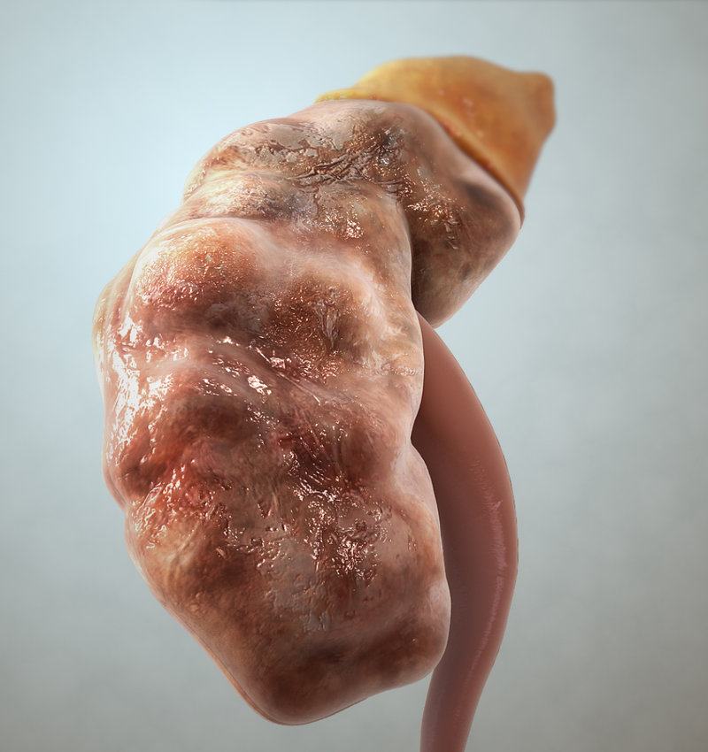 An illustration of a chronically affected kidney.